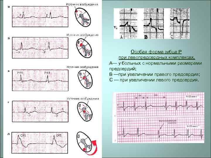 Особая форма зубца Р при левопредсердных комплексах. А— у больных с нормальными размерами предсердий;