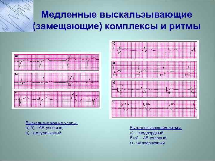 Медленные выскальзывающие (замещающие) комплексы и ритмы Выскальзывающие удары: а), б) – АВ-узловые; в) -