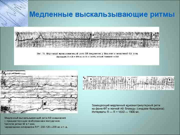 Медленные выскальзывающие ритмы Замещающий медленный идиовентрикулярный ритм на фоне ФП и полной АВ блокады