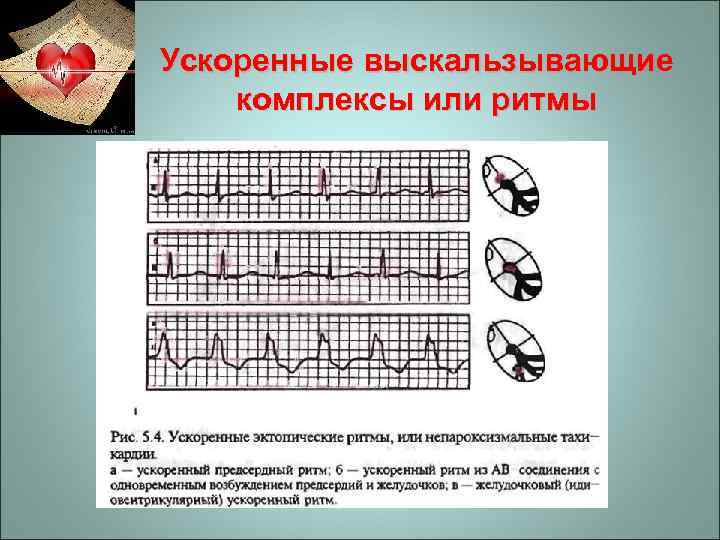 Ускоренные выскальзывающие комплексы или ритмы 