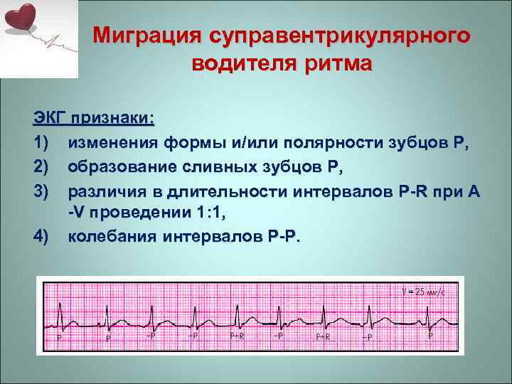 Миграция суправентрикулярного водителя ритма ЭКГ признаки: 1) изменения формы и/или полярности зубцов Р, 2)