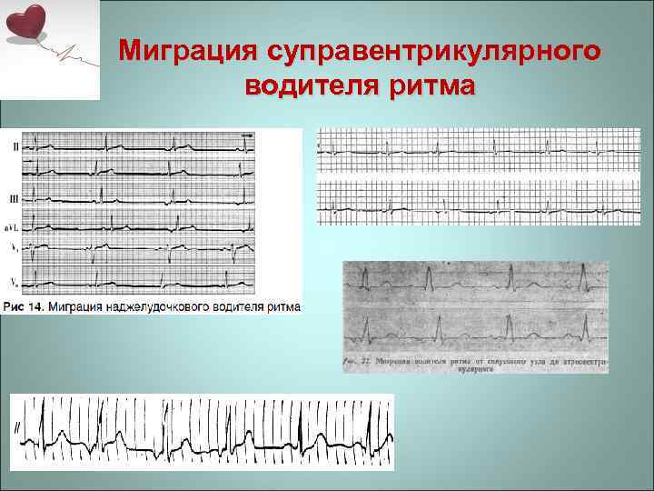 Миграция суправентрикулярного водителя ритма 