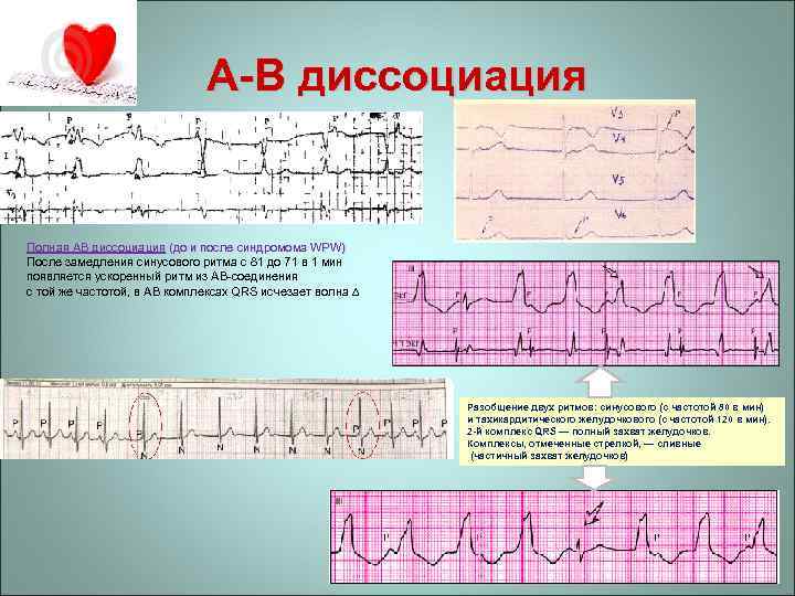 A-В диссоциация Полная АВ диссоциация (до и после синдромома WPW) После замедления синусового ритма