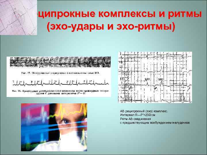 Реципрокные комплексы и ритмы (эхо-удары и эхо-ритмы) АВ реципрокный (эхо) комплекс. Интервал R—Р'=230 см