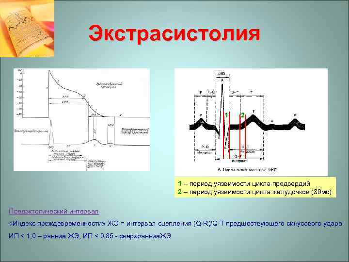 Экстрасистолия 1 2 1 – период уязвимости цикла предсердий 2 – период уязвимости цикла