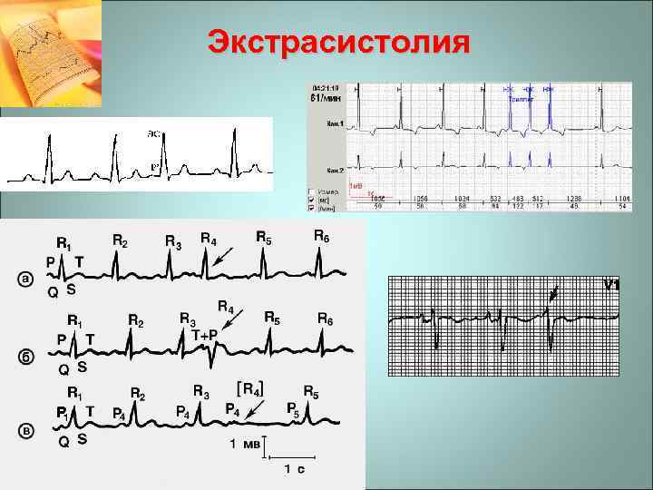 Экстрасистолия 