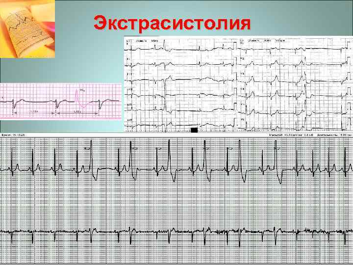 Экстрасистолия 