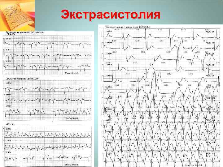 Экстрасистолия 