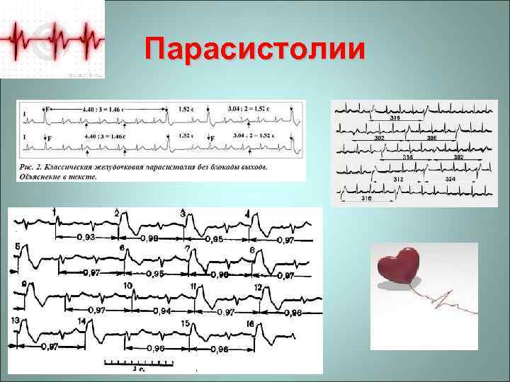 Парасистолии 