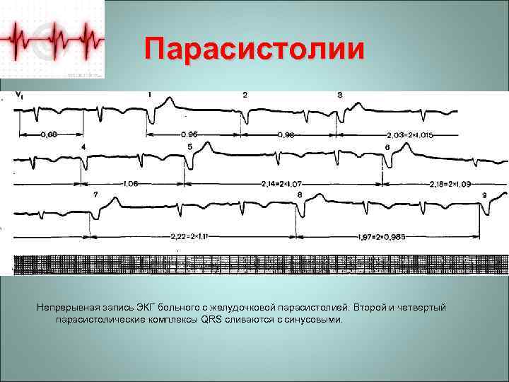 Парасистолии Непрерывная запись ЭКГ больного с желудочковой парасистолией. Второй и четвертый парасистолические комплексы QRS