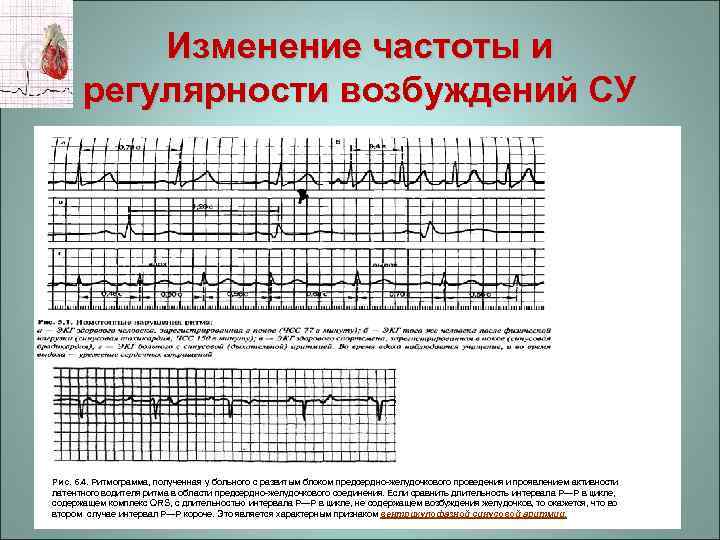 Изменение частоты и регулярности возбуждений СУ Рис. 6. 4. Ритмограмма, полученная у больного с