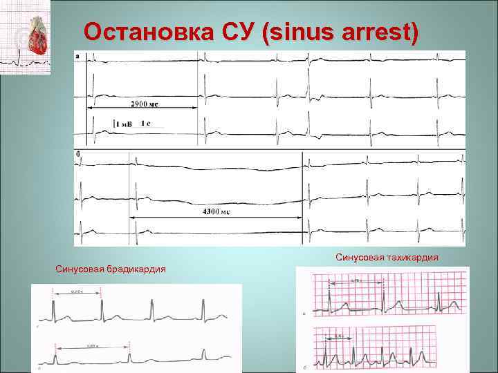 Остановка СУ (sinus arrest) Синусовая тахикардия Синусовая брадикардия 