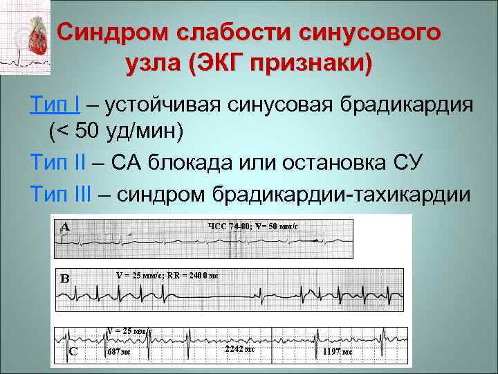 Синдром слабости синусового узла (ЭКГ признаки) Тип І – устойчивая синусовая брадикардия (< 50