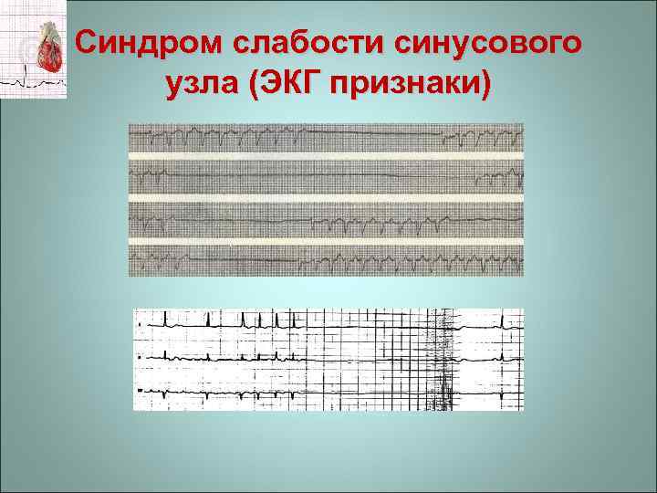 Синдром слабости синусового узла (ЭКГ признаки) 