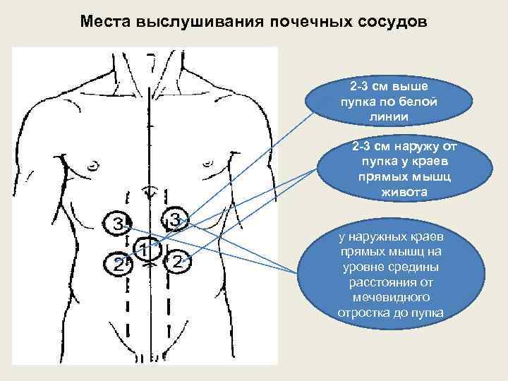 Места выслушивания почечных сосудов 2 -3 см выше пупка по белой линии 2 -3