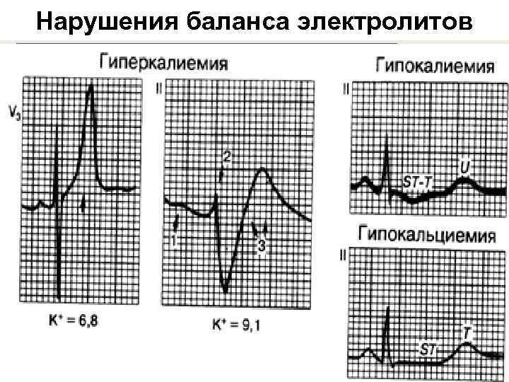 Нарушения баланса электролитов Гиперкалиемия (К, = 6, 8) характеризуется высоким острым зубцом Т. Тяжелая