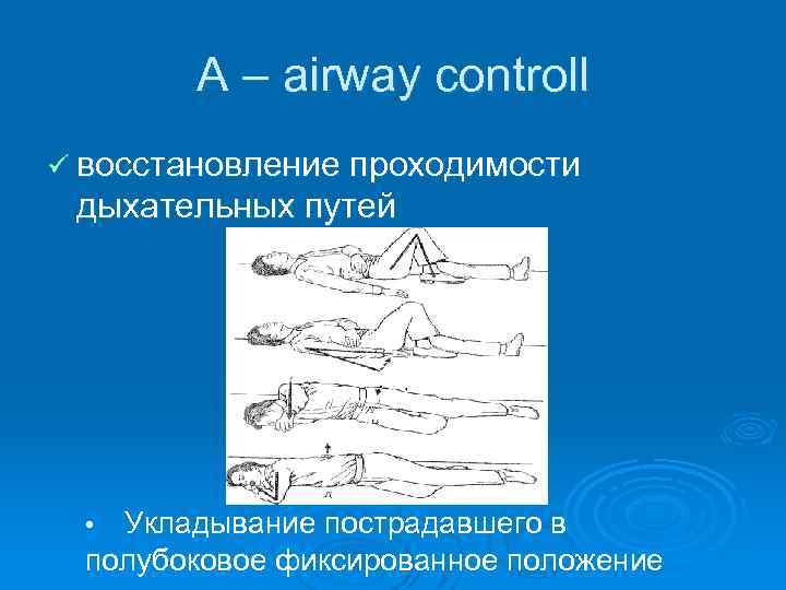 А – airway controll ü восстановление проходимости дыхательных путей Укладывание пострадавшего в полубоковое фиксированное