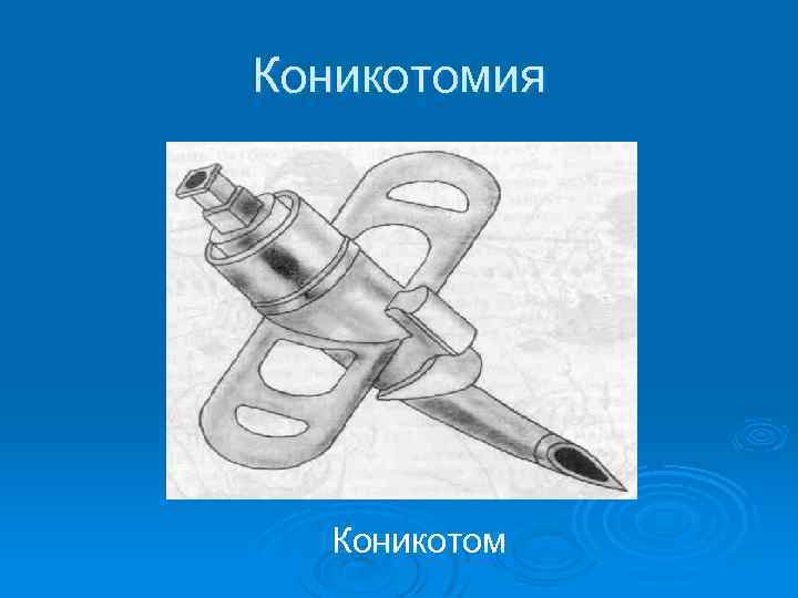 Коникотомия Коникотом 