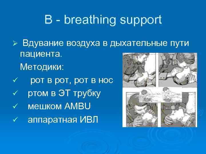 В - breathing support Вдувание воздуха в дыхательные пути пациента. Методики: ü рот в