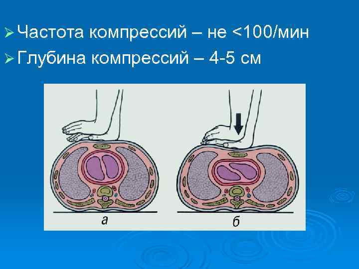 Ø Частота компрессий – не <100/мин Ø Глубина компрессий – 4 -5 см 