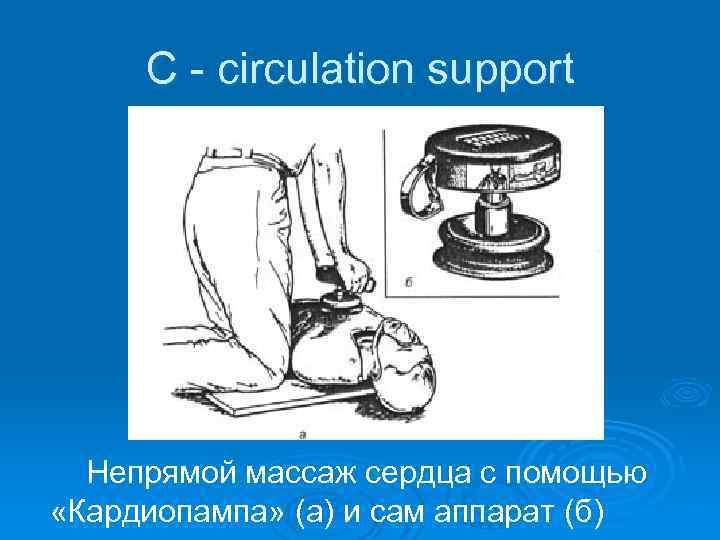 С - circulation support Непрямой массаж сердца с помощью «Кардиопампа» (а) и сам аппарат