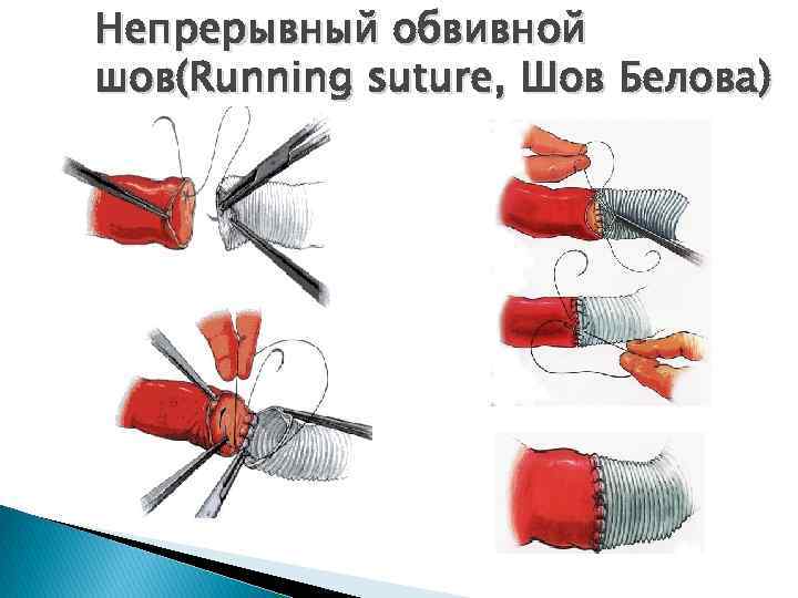 Непрерывный обвивной шов(Running suture, Шов Белова) 