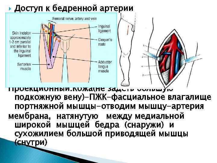  Доступ к бедренной артерии Проекционный: Кожа(не задеть большую подкожную вену)-ПЖК-фасциальное влагалище портняжной мышцы-отводим
