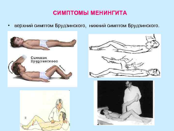 СИМПТОМЫ МЕНИНГИТА • верхний симптом Брудзинского, нижний симптом Брудзинского. 