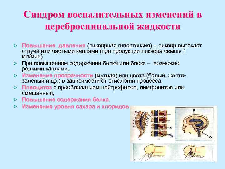 Синдром воспалительных изменений в цереброспинальной жидкости Ø Ø Ø Повышение давления (ликворная гипертензия) –