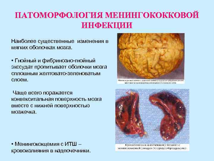 ПАТОМОРФОЛОГИЯ МЕНИНГОКОККОВОЙ ИНФЕКЦИИ Наиболее существенные изменения в мягких оболочках мозга. • Гнойный и фибринозно-гнойный