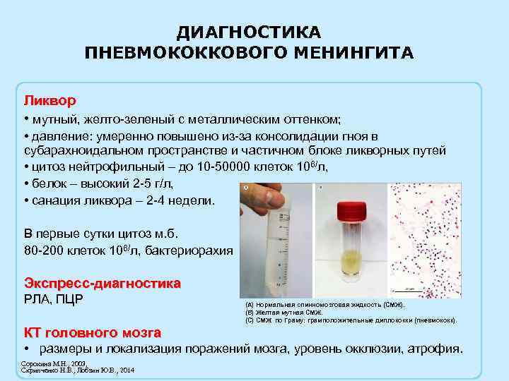 ДИАГНОСТИКА ПНЕВМОКОККОВОГО МЕНИНГИТА Ликвор • мутный, желто-зеленый с металлическим оттенком; • давление: умеренно повышено