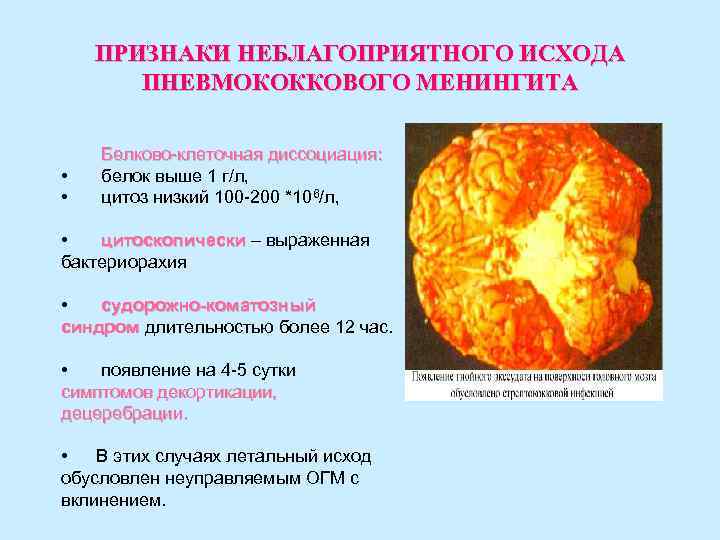 ПРИЗНАКИ НЕБЛАГОПРИЯТНОГО ИСХОДА ПНЕВМОКОККОВОГО МЕНИНГИТА • • Белково-клеточная диссоциация: белок выше 1 г/л, цитоз