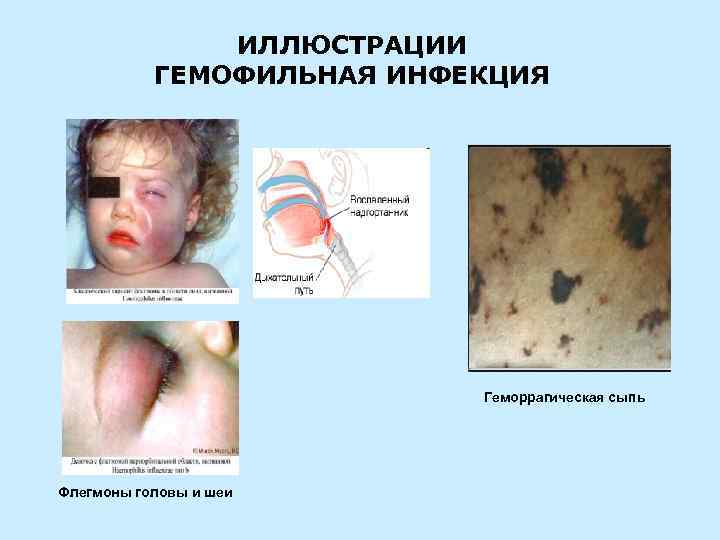 ИЛЛЮСТРАЦИИ ГЕМОФИЛЬНАЯ ИНФЕКЦИЯ Геморрагическая Флегмоны головы и шеи сыпь 