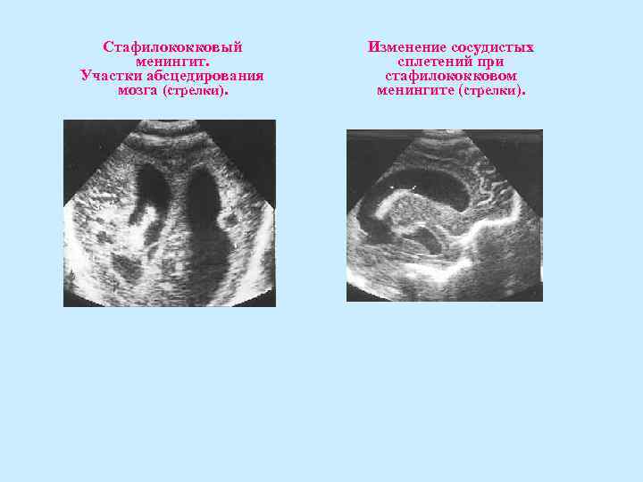 Стафилококковый менингит. Участки абсцедирования мозга (стрелки). Изменение сосудистых сплетений при стафилококковом менингите (стрелки). 