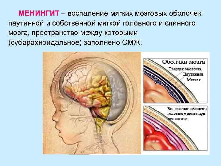 МЕНИНГИТ – воспаление мягких мозговых оболочек: МЕНИНГИТ паутинной и собственной мягкой головного и спинного