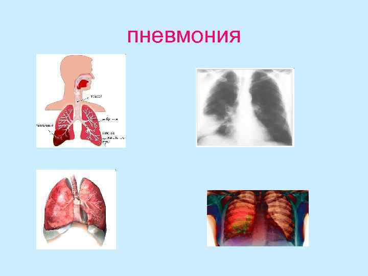 пневмония 