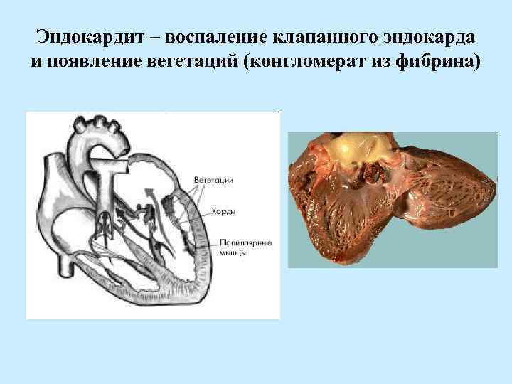 Эндокардит – воспаление клапанного эндокарда и появление вегетаций (конгломерат из фибрина) 