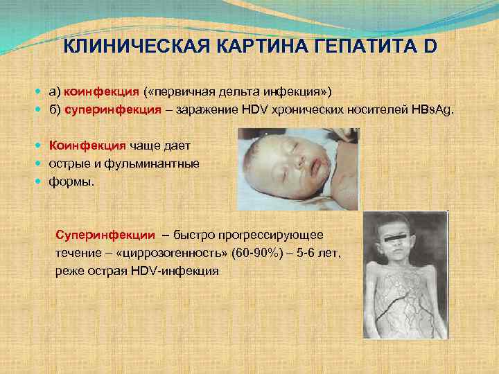 КЛИНИЧЕСКАЯ КАРТИНА ГЕПАТИТА D а) коинфекция ( «первичная дельта инфекция» ) б) суперинфекция –