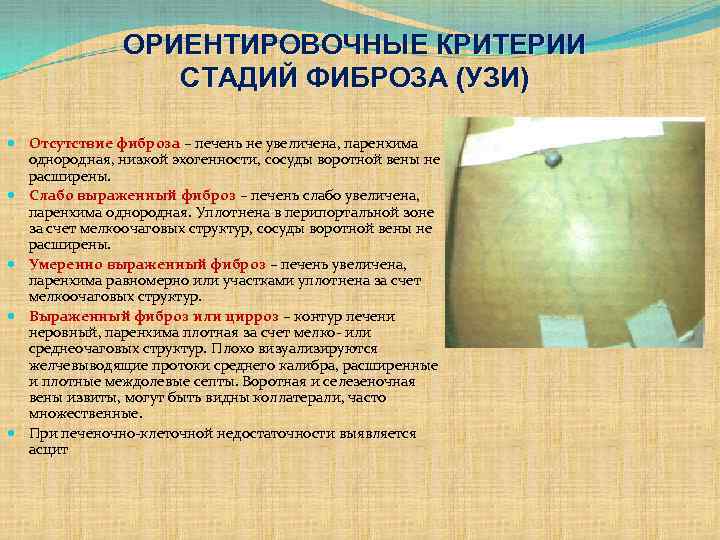 ОРИЕНТИРОВОЧНЫЕ КРИТЕРИИ СТАДИЙ ФИБРОЗА (УЗИ) Отсутствие фиброза – печень не увеличена, паренхима однородная, низкой