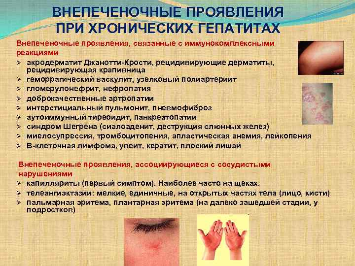 ВНЕПЕЧЕНОЧНЫЕ ПРОЯВЛЕНИЯ ПРИ ХРОНИЧЕСКИХ ГЕПАТИТАХ Внепеченочные проявления, связанные с иммунокомплексными реакциями Ø акродерматит Джанотти-Крости,