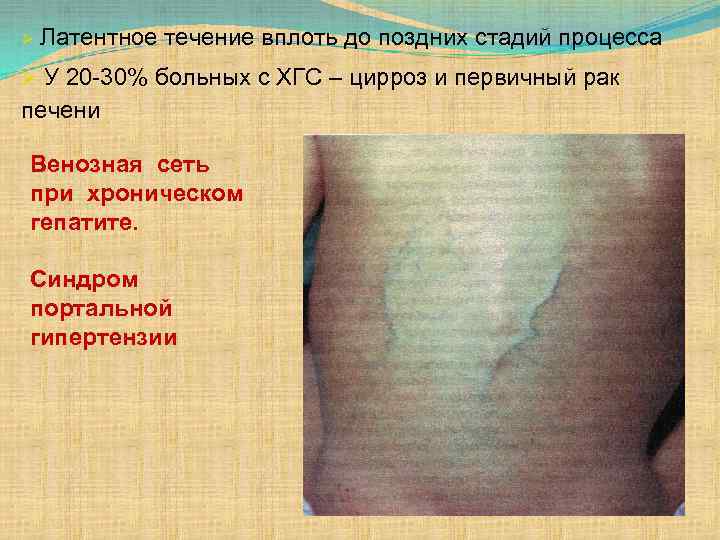 Ø Латентное течение вплоть до поздних стадий процесса Ø У 20 -30% больных с