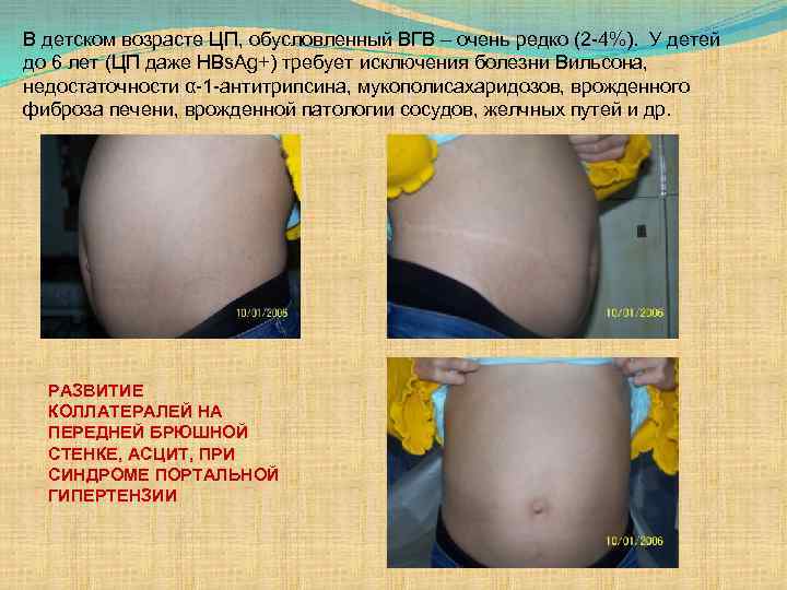 В детском возрасте ЦП, обусловленный ВГВ – очень редко (2 -4%). У детей до