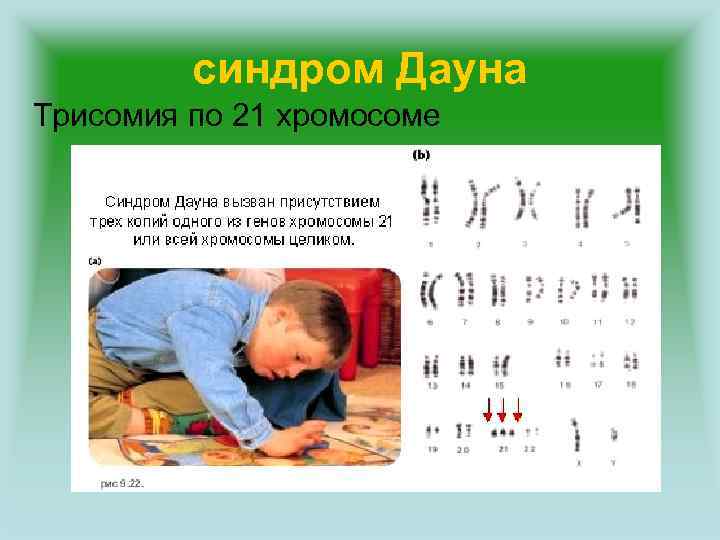 синдром Дауна Трисомия по 21 хромосоме 