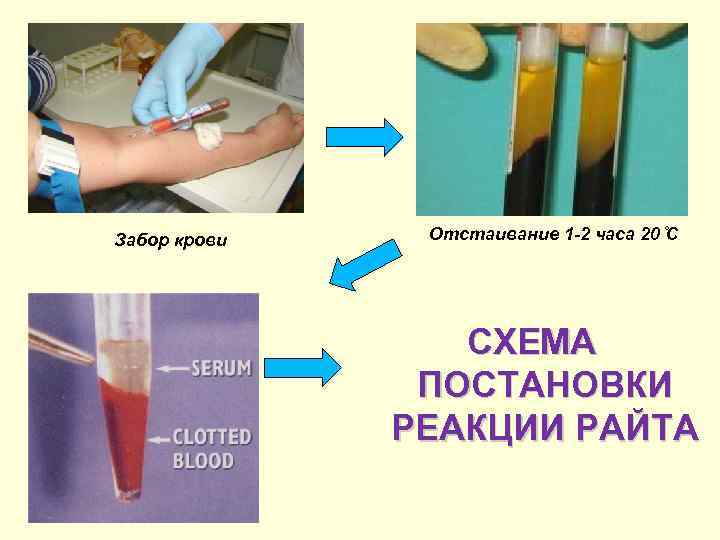 Забор крови Отстаивание 1 -2 часа 20 С СХЕМА ПОСТАНОВКИ РЕАКЦИИ РАЙТА 