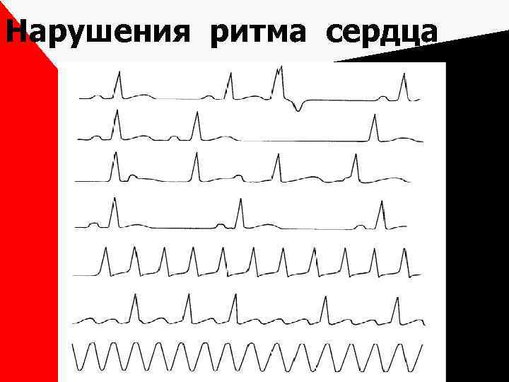 Нарушения ритма сердца 
