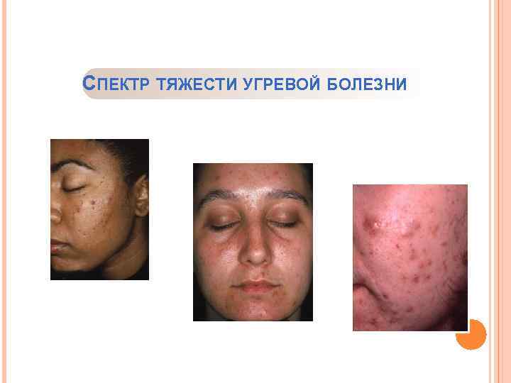 СПЕКТР ТЯЖЕСТИ УГРЕВОЙ БОЛЕЗНИ Слабая Умеренная Тяжелая 