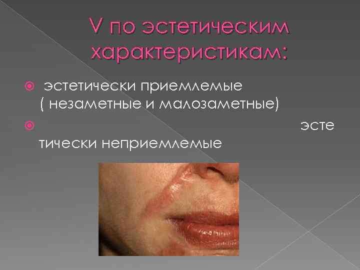 V по эстетическим характеристикам: эстетически приемлемые ( незаметные и малозаметные) эсте тически неприемлемые 