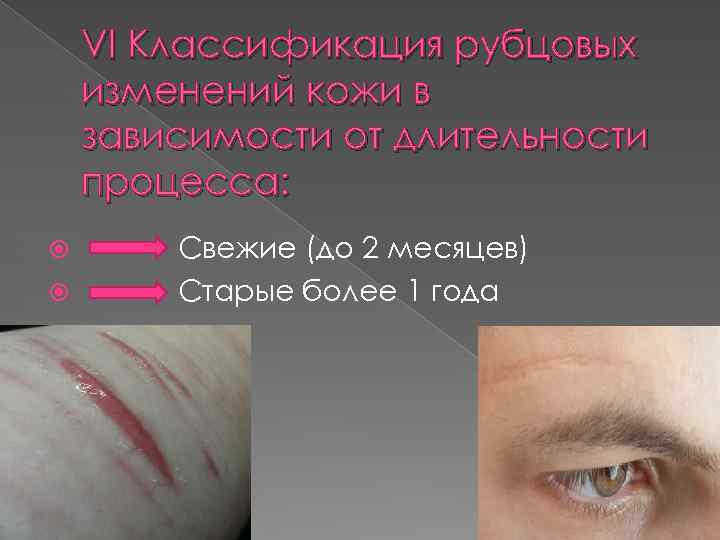 VI Классификация рубцовых изменений кожи в зависимости от длительности процесса: Свежие (до 2 месяцев)