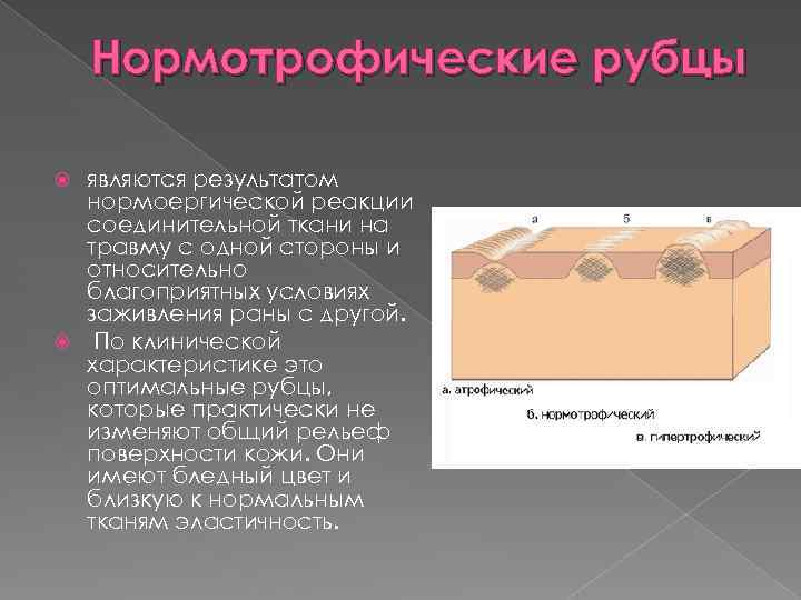 Нормотрофические рубцы являются результатом нормоергической реакции соединительной ткани на травму с одной стороны и