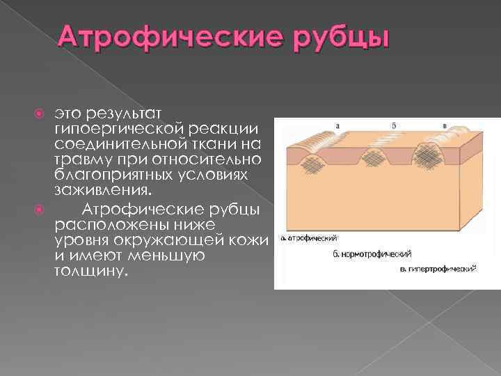 Атрофические рубцы это результат гипоергической реакции соединительной ткани на травму при относительно благоприятных условиях